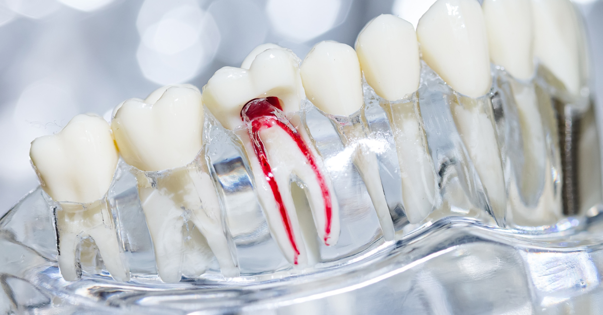root canal
