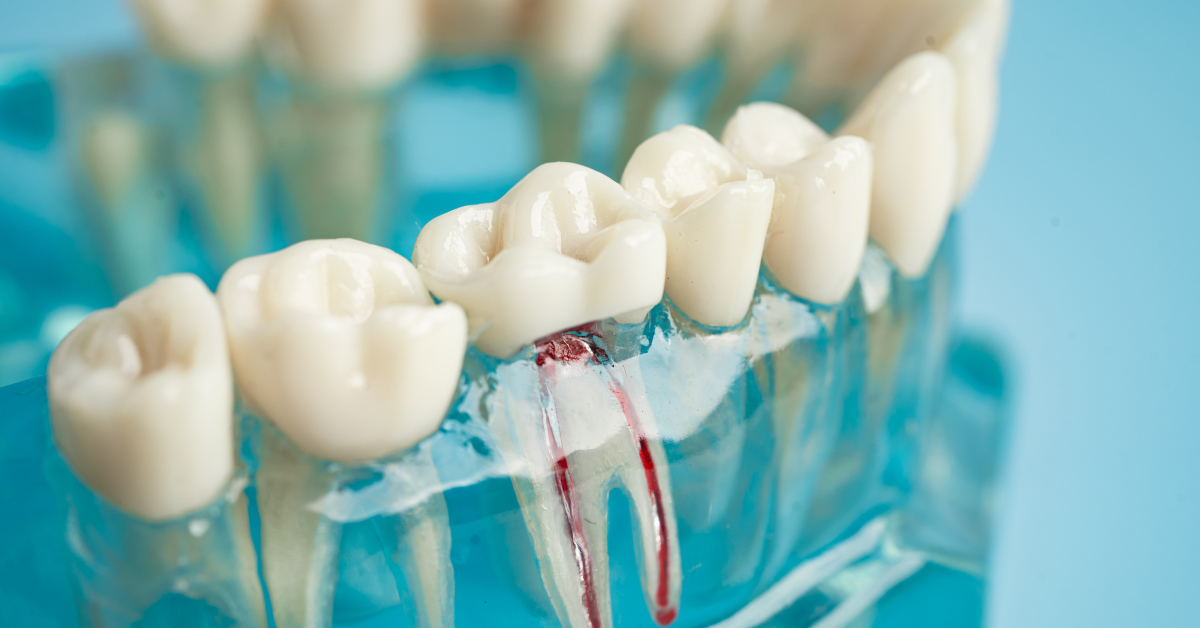 root canal therapy