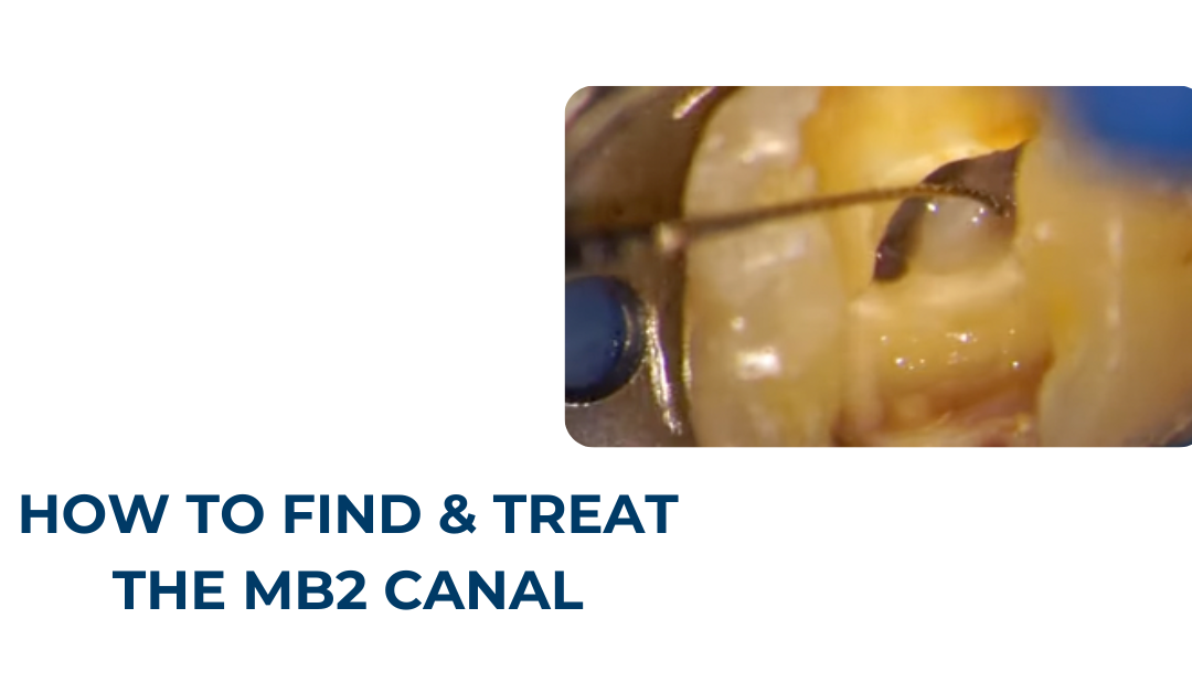 mb2 canal treatment